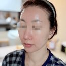 (주)미희 | 신논현피부과 콜라겐주사 미희주사 팔자주름 후기