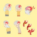 뇌졸중 이미지
