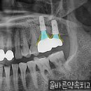 신흥치과기공소 네이버블로그