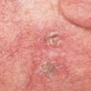 광선 각화증 (Actinic Keratosis) 피부질환이란? 이미지