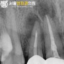 능곡치과의원 | 능곡역 치과 잇몸 부었을 때 신경치료 후기