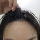 꼼꼼약국 | 생각보다 간단했던 이마축소 수술 당일 후기 (운전 출근 마취 시간 주의사항)