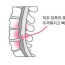 목뒤 통증 목뒤 결림 경추부 후종인대 골화증 이미지