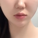 (주)압구정하루 | 압구정역 피부과 지방파괴주사 이중턱 파괴괴 변화 후기