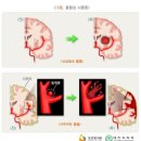 뇌혈관질환 분류표와 뇌혈관질환(Ⅰ) 분류표 뇌혈관질환(Ⅱ) 분류표의 비교 이미지