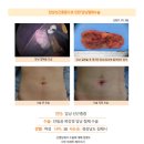 담낭선근종증수술후기. 건강검진 초음파 결과 담낭 선근종증 진단을 받아 1년간 우루사를 복용하며... 이미지