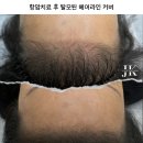 제이부티크 | 광주두피케어로 다시 웃게 된 날, 제이케이두피부띠크 실제 방문 후기