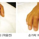 동성 보조기 이미지