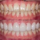 성형치과기공소 | 라미네이트 8개+하악미백으로 완성한 밝고 화사한 셀러브리티 라인 사례.디지털로 서울블랑치과