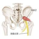 이상근증후군 증상 및 원인 검사 치료 이미지