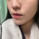 벨뷰의원 | 강남역 벨뷰의원 리니어펌 600샷 + 코조각주사 솔직 후기