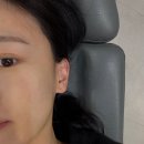 탑통증연합의원 | 건대 예쁨주의 쁨의원 :: 스킨부스터 ' 필로드 ' 2cc 맞은 솔직 후기(리쥬란 통증 비교/전후 사진 有)