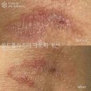 콜드플라즈마 이미지