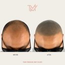 TMW 탈모왕수원 이미지