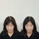 도트바이림 | 대전smp ‘도트바이림’ 정수리 가르마 탈모관리 부모님 후기