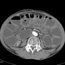 mechanical ileus 이미지