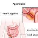 여자 맹장 위치 터지는 이유는남자 이미지