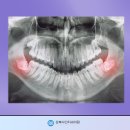 쌍문역 강북다인치과에서 일상생활의 방해꾼 사랑니 발치에 대해 알려드립니다 이미지