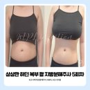 상상 복부 팔 지방분해주사의원 5회차 후기, -5kg 감량 변화