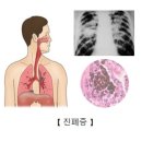 진폐증[pneumoconiosis] 이미지