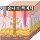 바름다운필라테스 | 엠페이스 리프팅 가격 효과 부작용 후기(+다까발림!!)