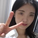 딱지 | 압구정 반딧불 의원, 딱지 레이저 & 레이저 토닝 내돈내산 후기