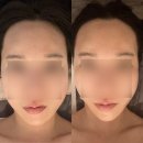 내돈내산 약손명가 청주가경점 10회 리얼 후기! 청주 윤곽관리, 비대칭관리 왕추천!