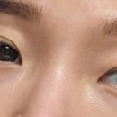 나심바 | 출산·육아 후 다크서클 고민 끝에 눈밑필러 2cc 내돈내산 후기 (약3주 경과) 기록용