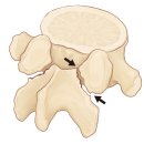 척추 분리증[spondylolysis] 이미지