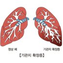 기관지 확장증 이미지