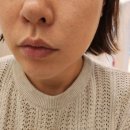 대구 피부과 팔자필러추천 즉각적인 효과