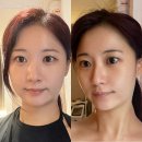 강남피부관리 비키슬림앤바디에서 페이스비타노소관리 받고 온 날