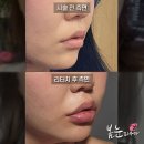 대영빌딩 | 입술필러 후기, 보정 없는 실제 후기 보고 싶은 분만 읽어보세요