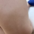 광적어린이집 | 아기 기저귀 발진으로 병원 다녀온 후기