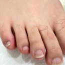 레푸스인하대역점 내성발톱 무좀발톱 발각질 문제성발 이미지