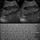 Complex cysts of the kidney (complex renal cysts) 이미지