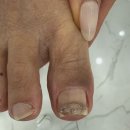 동성제약 풀리메디 연희점 | 군포내성발톱으로 고생하다 찾은 곳, 풋네일 동성제약 풀리메디 군포산본점 솔직 후기
