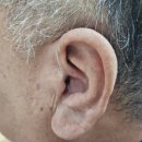 청음 독일보청기 이미지