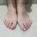 대화동 내성 발톱무좀 병원에서 깔끔한 변화