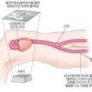 관상동맥 조영술[coronary angiography, CAG] 질환이란? 이미지