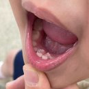 만5세 아랫니 설측맹출 치아 발치 (유치 빠지기전 영구치)