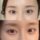 달아이 | 예비신부 내돈내산 아이리쥬란 한달 후기｜눈밑꺼짐 효과, 멍·엠보·통증 리얼후기