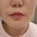 드레스성형외과의원 | 얇은입술 컴플렉스 드레스성형외과에서 입술필러 맞고 극뽁-!