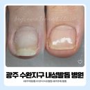 광주 내성발톱 병원, 수완지구에서 2만 원으로 관리받은 후기