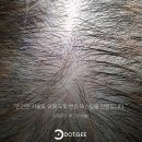 [수원두피문신] 가르마 정수리 탈모의 원인과 자연스러운 SMP 커버 방법
