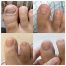 홈케어생명약국 | 여자발톱무좀 치료약(피부과X) 홈케어 후기