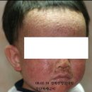 강남 아토피 경희 신창한의원 치료 사례
