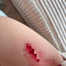 더드림병원 | 아이 허벅지 찢어짐 119→18바늘 봉합 후기 및 봉합후 관리법 #강남더드림병원