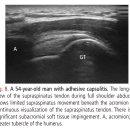 Re: 어깨 충돌증후군(중립, 외전) 견봉~상완골두 거리 초음파 검사 관찰자 사이 일치도 유용성!! 이미지