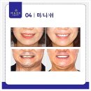 스마트치과기공소 | 비절개 치아 복원 미니쉬– 비용, 효과, 실제 후기 총정리